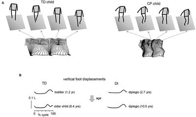 Clinical Relevance of State-of-the-Art Analysis of Surface Electromyography in Cerebral Palsy